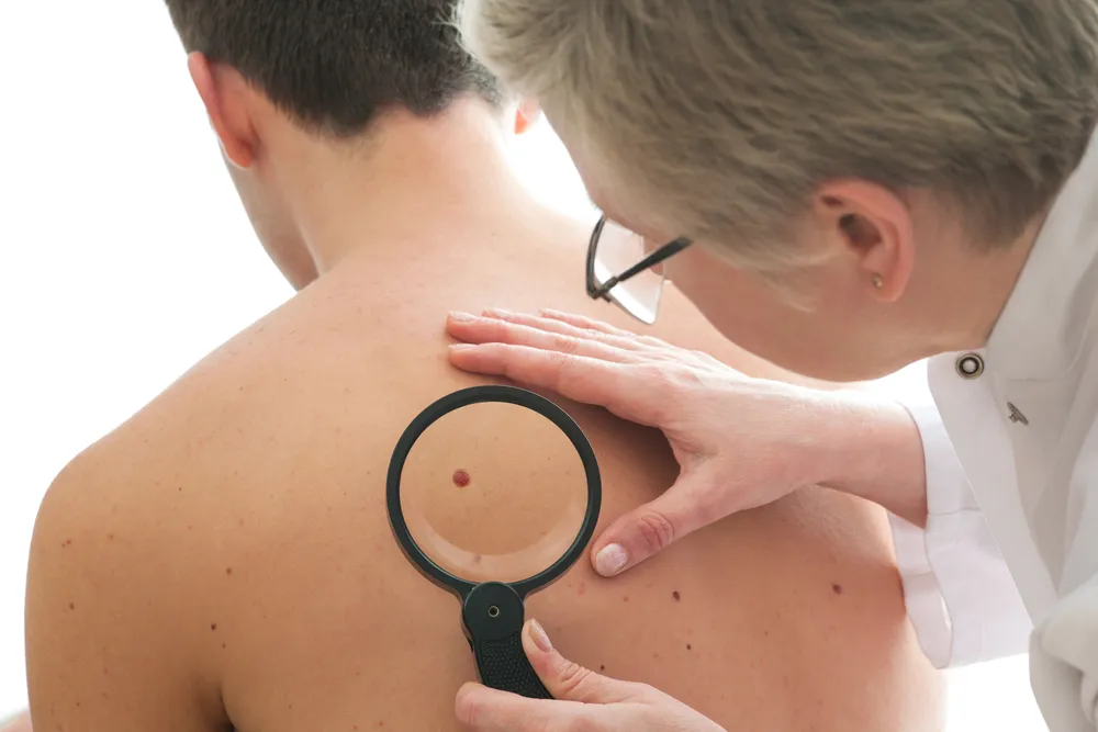 Signs and Symptoms of Non-Melanoma Skin Cancer