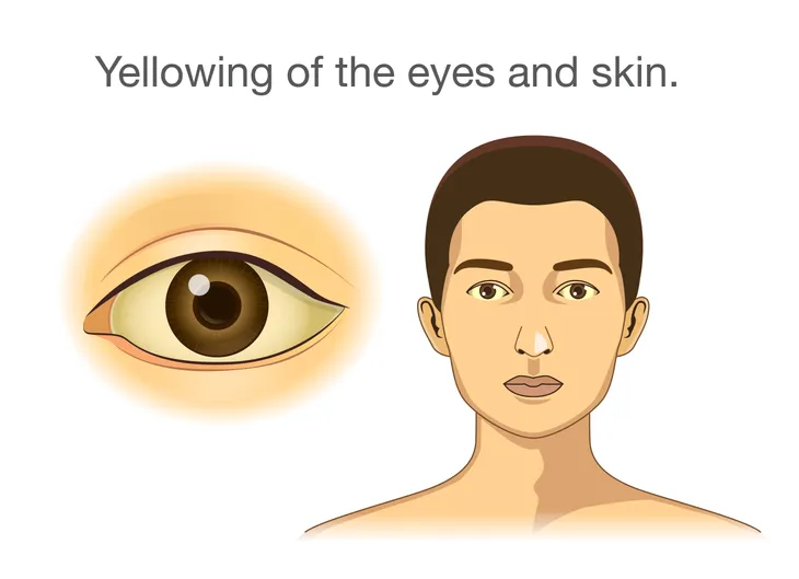 Yellow Eyes: Causes, Symptoms, And Treatment