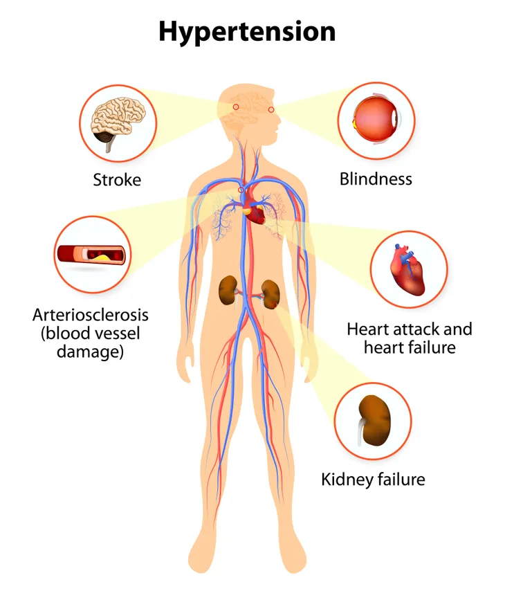 Diagram of Hypertension