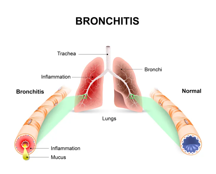 laryngitis diagram