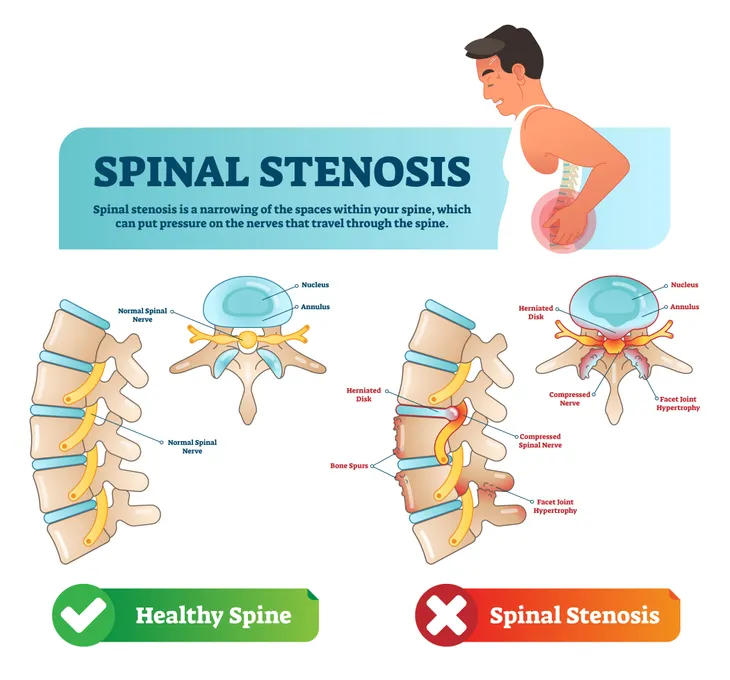 Spinal stenosis - Symptoms and causes - Mayo Clinic