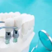 Cómo los implantes dentales brindan la sonrisa perfecta