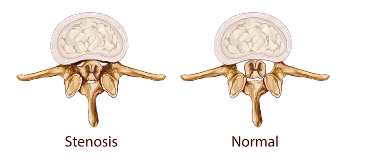 Spinal stenosis - Symptoms and causes - Mayo Clinic