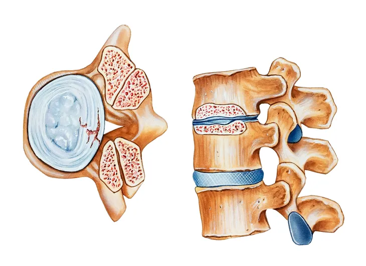 Spinal stenosis - Symptoms and causes - Mayo Clinic