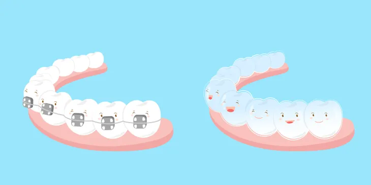 Pros and Cons of Invisalign Braces