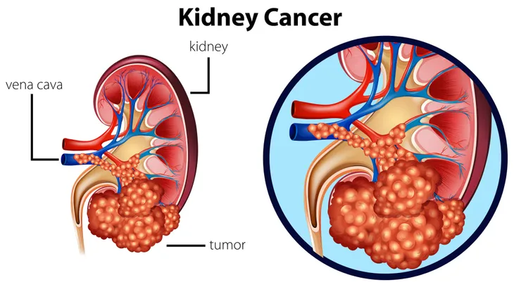 11 Signs and Symptoms of a Kidney Infection – ActiveBeat – Your Daily Dose  of Health Headlines