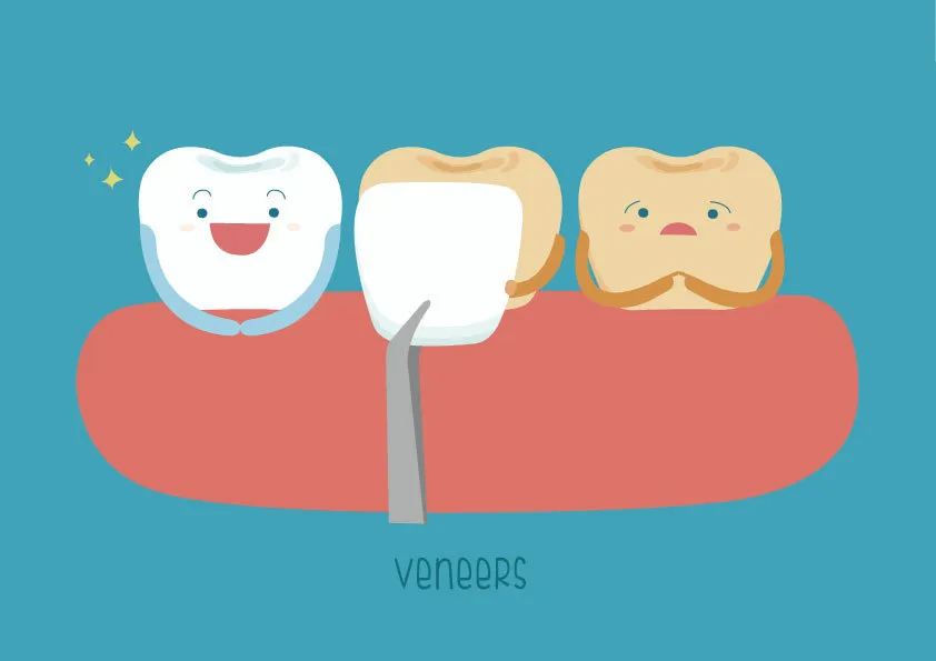What to Know Before Getting Dental Veneers