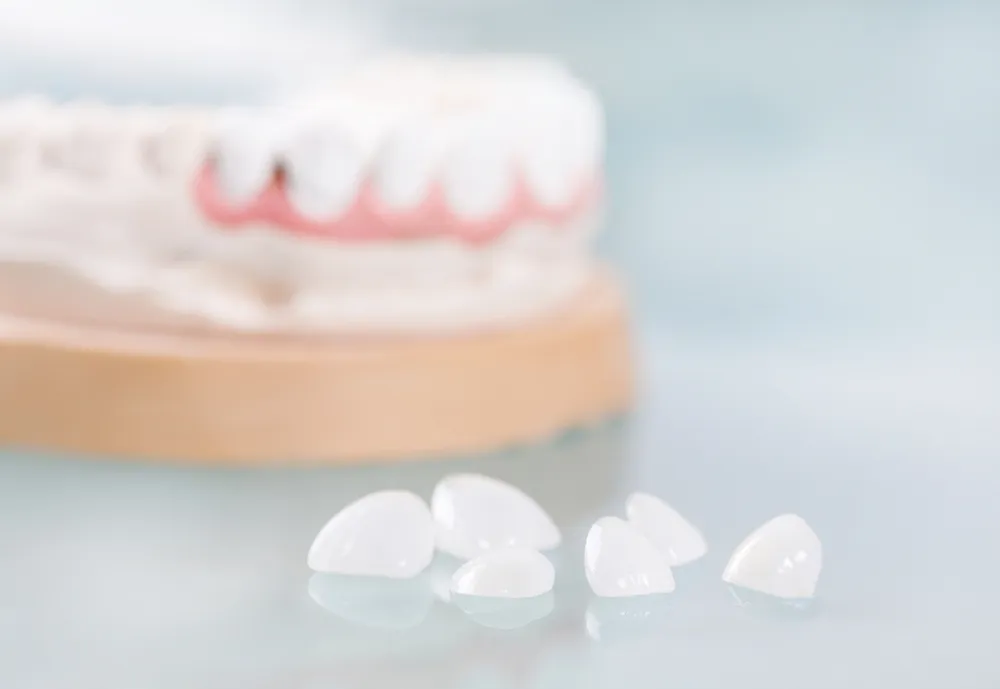 Pros and Cons of Dental Veneers