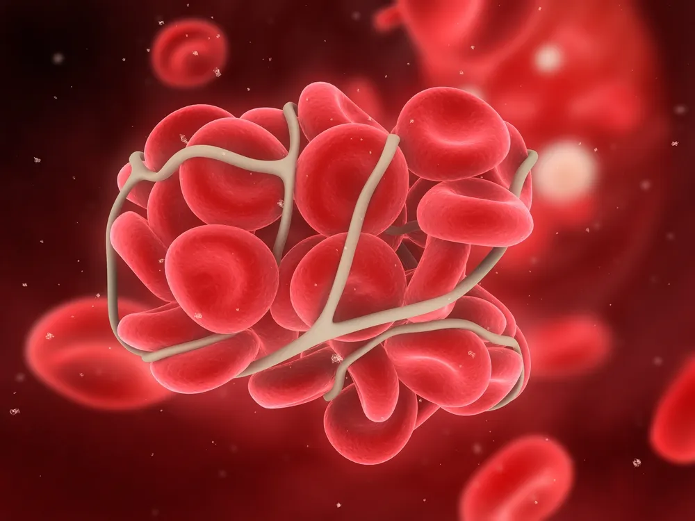 15 sinais e sintomas comuns de um coágulo sanguíneo
