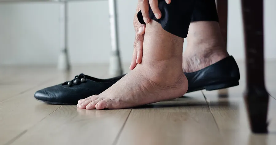 Edema: Symptoms, Types, Causes, and Treatment