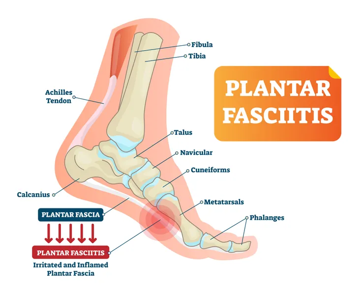 Plantar fasciitis: Symptoms, causes, and treatments - Harvard Health