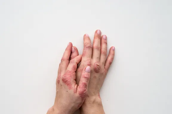 Signs and Symptoms of Psoriasis