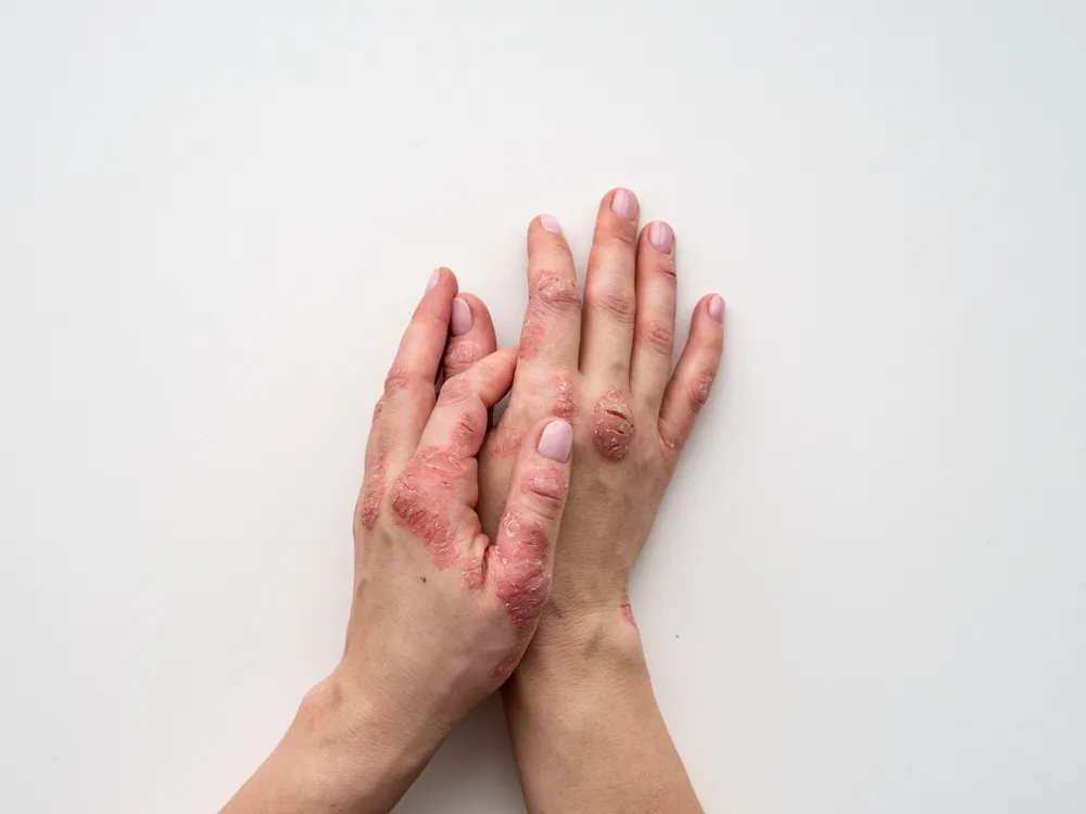 Signs and Symptoms of Psoriasis