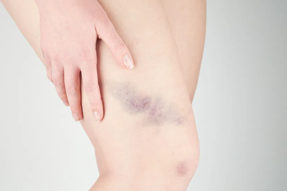 Reasons You Bruise So Easily