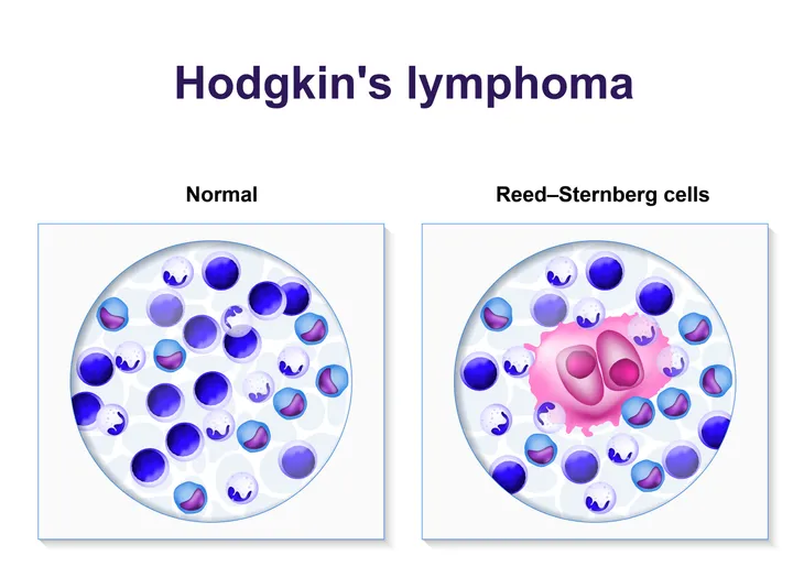 What's the difference between Hodgkin and non-Hodgkin lymphoma?