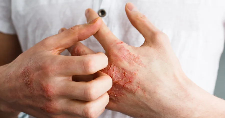 Eczema: Signs, Symptoms, and Treatment Options