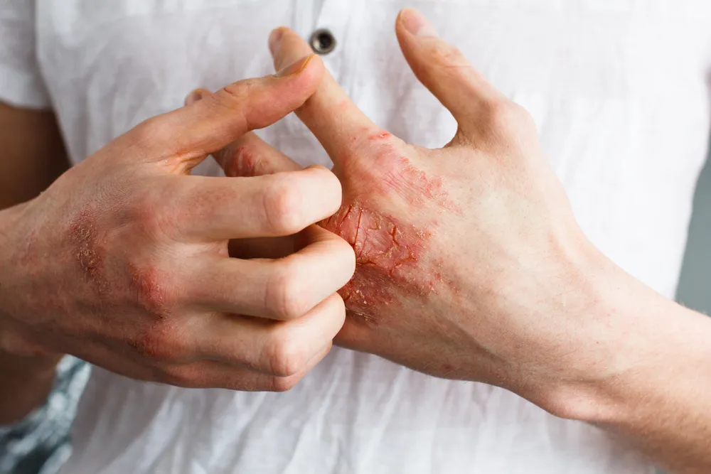 Eczema: Signs, Symptoms, and Treatment Options