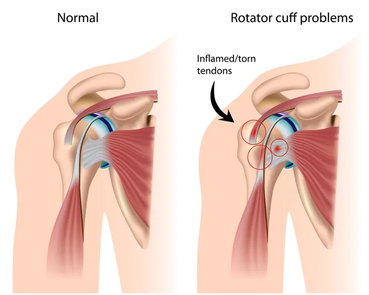 MRI of torn rotator cuff - Mayo Clinic