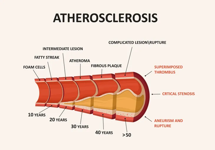 Atherosclerosis diagram