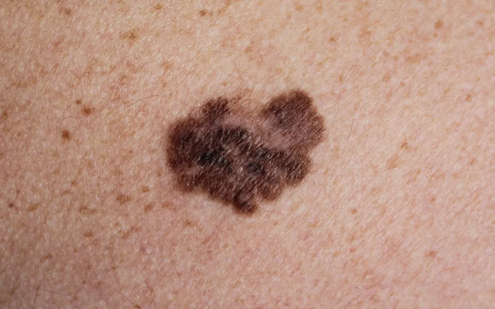 Everything You Need to Know About Melanoma