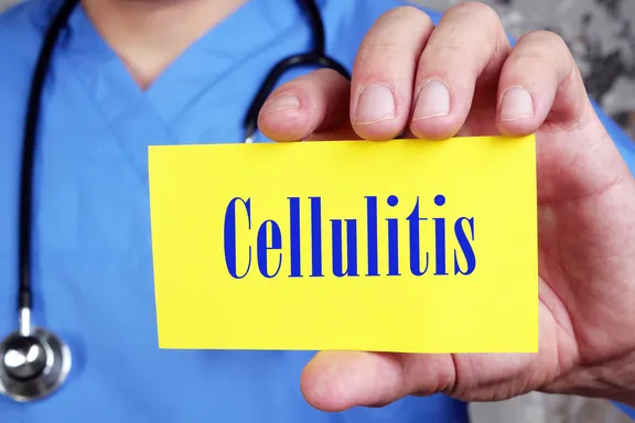 What's Cellulitis? A Dermatologist Explains