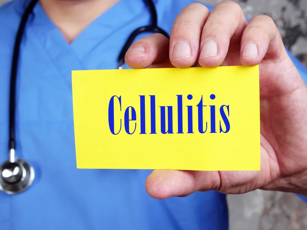 What’s Cellulitis? A Dermatologist Explains