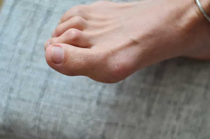 How To Prevent Bunions