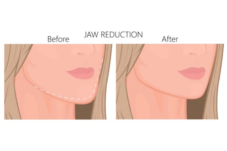 jawline reduction plastic surgery