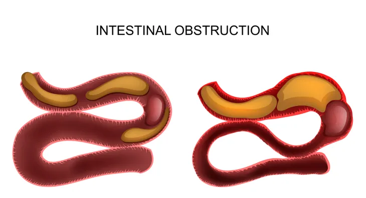 Bowel Obstruction or Intestinal Blockage