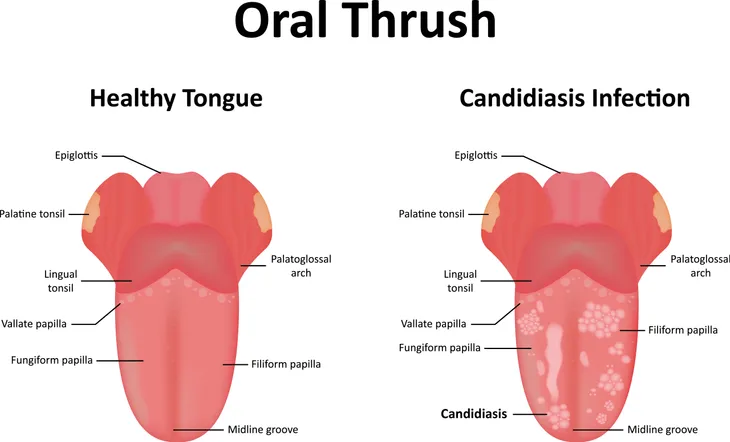 Thrush on deals tongue in adults