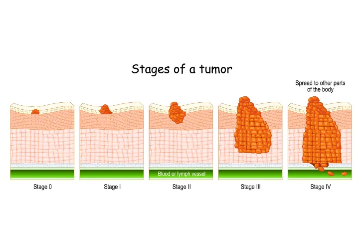 What Are the 4 Stages of Cancer? – ActiveBeat – Your Daily Dose of ...