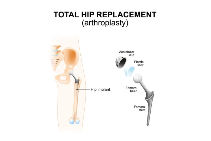 Hip Replacement Surgery: Purpose, Preparation, and Recovery – ActiveBeat –  Your Daily Dose of Health Headlines