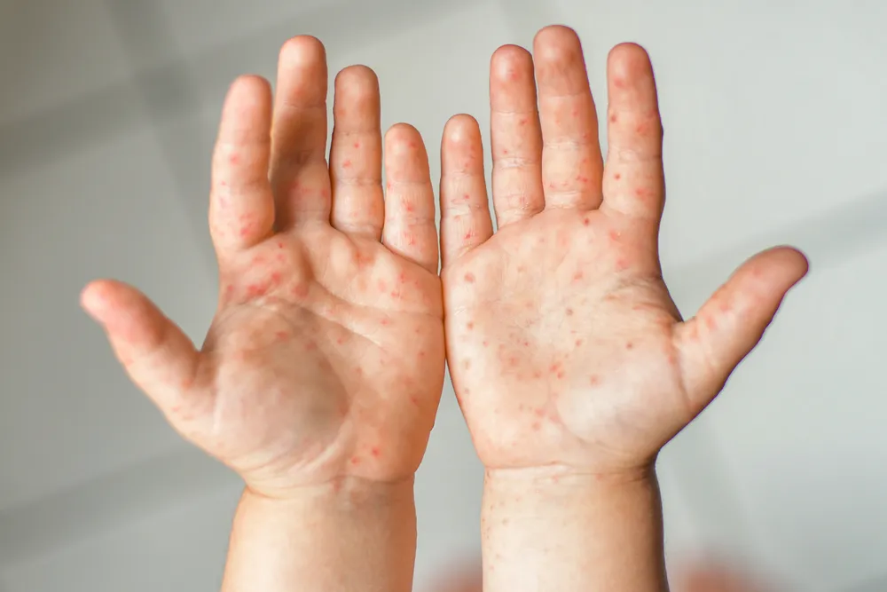 La maladie des mains, pieds et de la bouche : symptômes et traitements