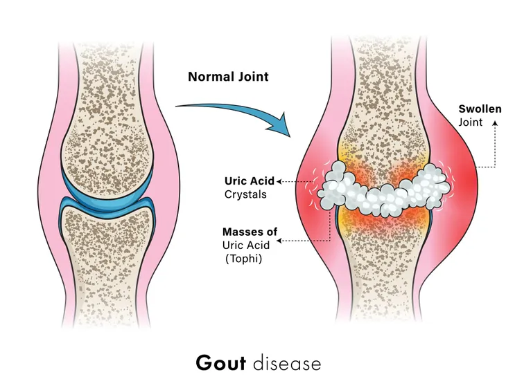 Uric Acid