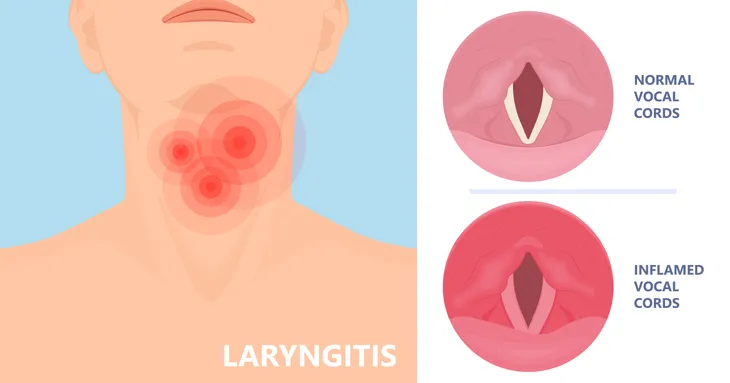 Laryngitis Symptoms Causes And Treatment Activebeat Your Daily Dose Of Health Headlines