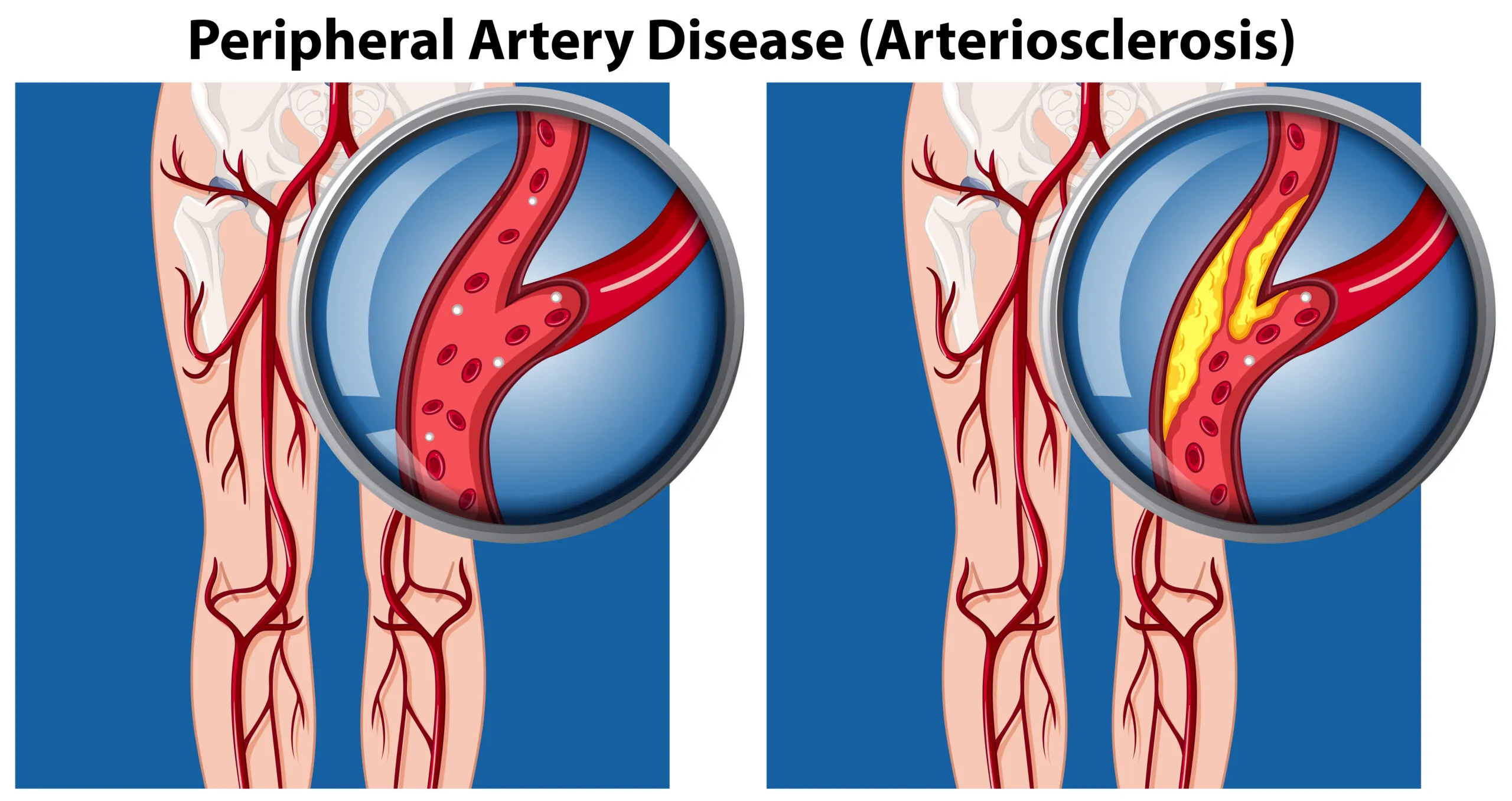 Peripheral Artery Disease (PAD): Symptoms, Causes, and Treatment