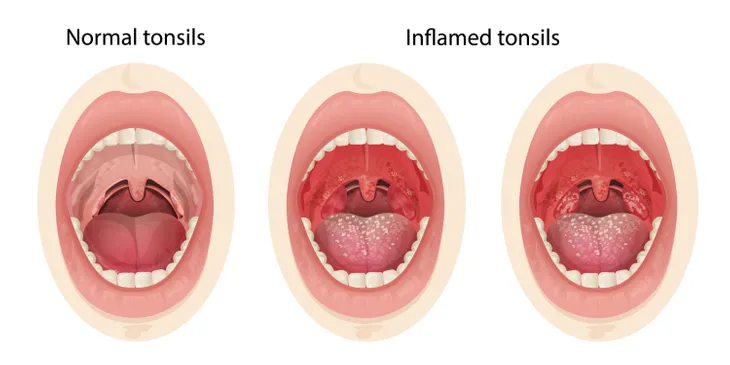 Acute tonsillitis