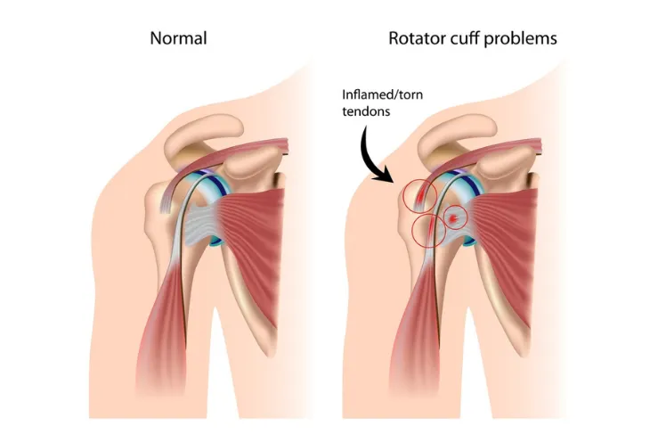 Top 10 Exercises and Stretches for Rotator Cuff Injury  Blog by CB  Physiotherapy, Active Healing for Pain Free Life.