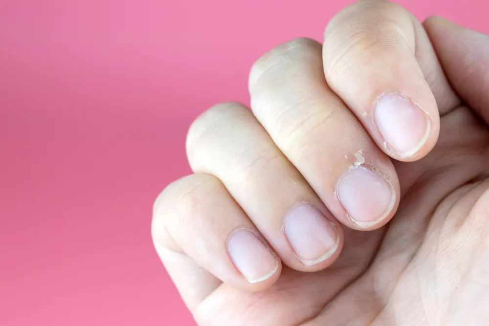 Effective Home Remedies for Hangnails