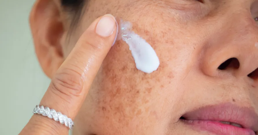 Melasma: Signs, Causes, Treatment, and Prevention