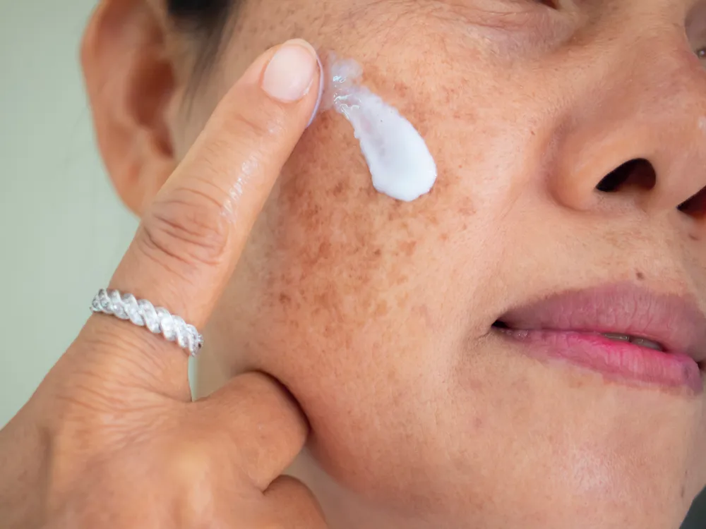 Melasma: Signs, Causes, Treatment, and Prevention