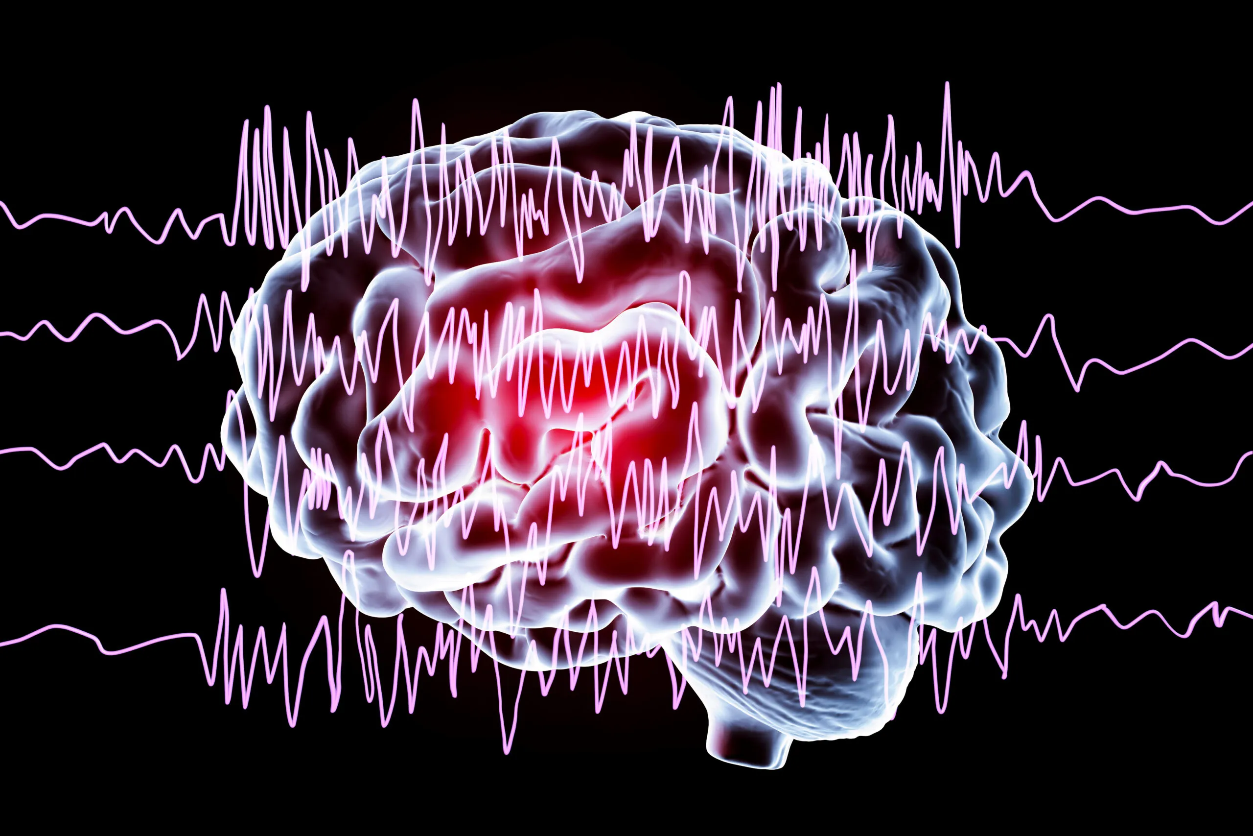 Silent, Subtle and Unseen: How Seizures Happen and Why They’re Hard to Diagnose