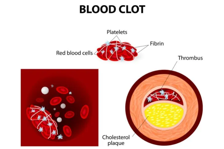 Don't let the clots freak you out! 🩸✨ It's time to debunk the myth that blood  clots indicate a serious health problem. 🙅‍♀️