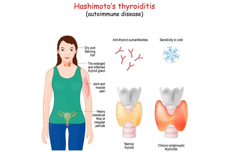 Postpartum thyroiditis: Symptoms, treatment, and more