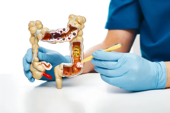 Colon Polyps: Signs, Causes, Treatment, and Prevention
