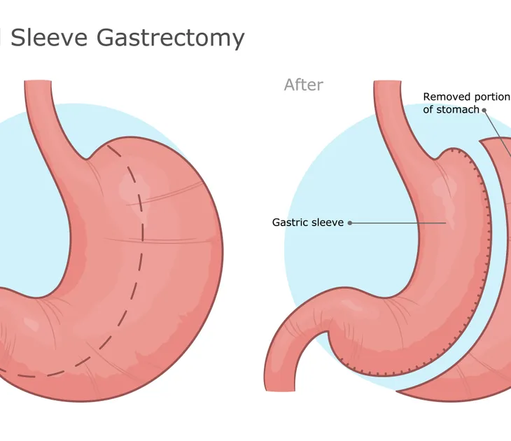 What Is a Gastric Sleeve Surgery?