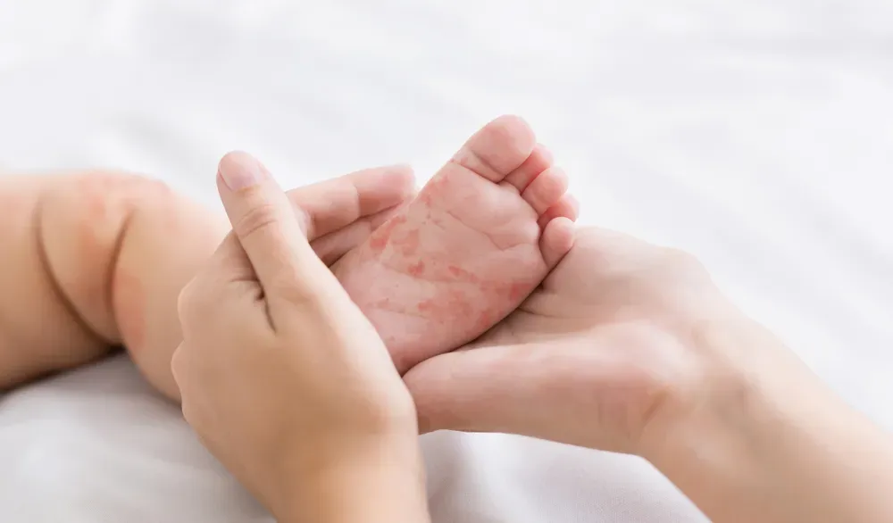 Roseola Signs & Symptoms: How To Tell If Your Child Has Roseola