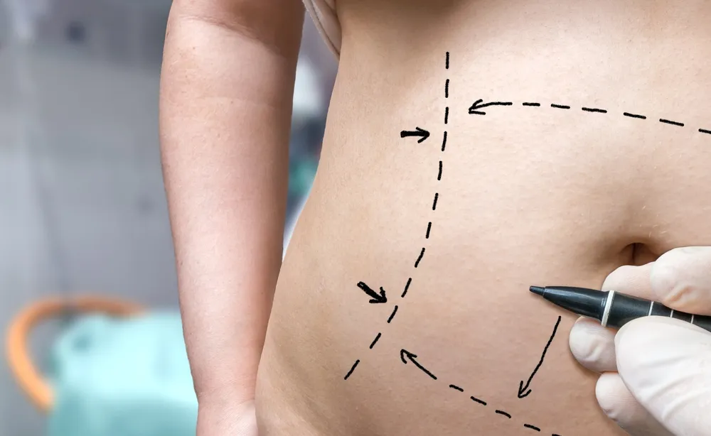How Much Does a Tummy Tuck Cost?