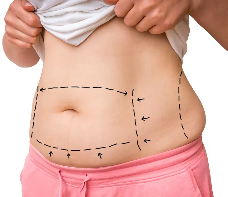 How Much Is a Tummy Tuck: Why the Cost Varies